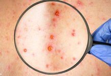 Atât se poate! Jumătate din cele circa 500 de cazuri de rujeolă din județul Brașov, înregistrate într-o comună cu o mare comunitate de romi care refuză vaccinarea din motive religioase