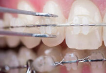 Ce fel de aparat dentar mi se potriveşte?