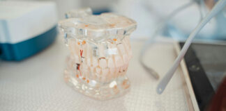 Punte sau implant dentar – care tratament durează mai mult și cât de repede poți avea o dantură completă