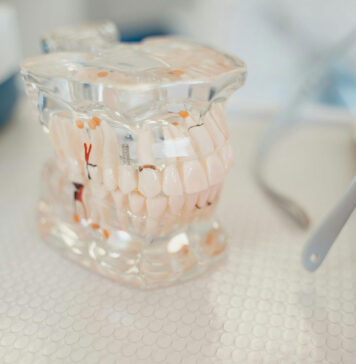 Punte sau implant dentar – care tratament durează mai mult și cât de repede poți avea o dantură completă